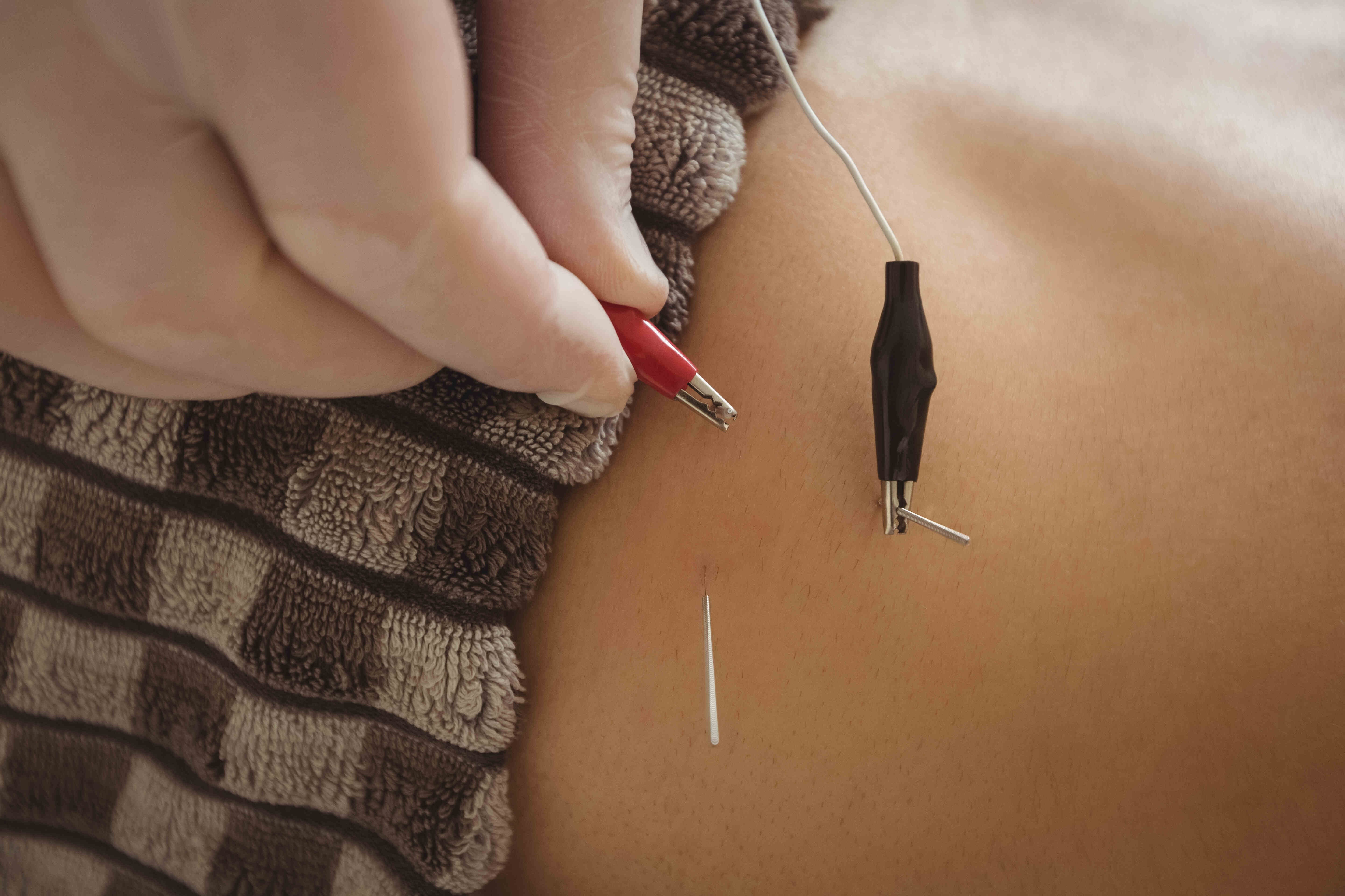 Acupunturist